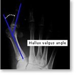 hallux-angle