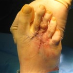hammer toe surgery