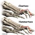 hammertoe-clawtoe