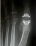 joint-replacement1