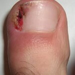 ingrown-nail2