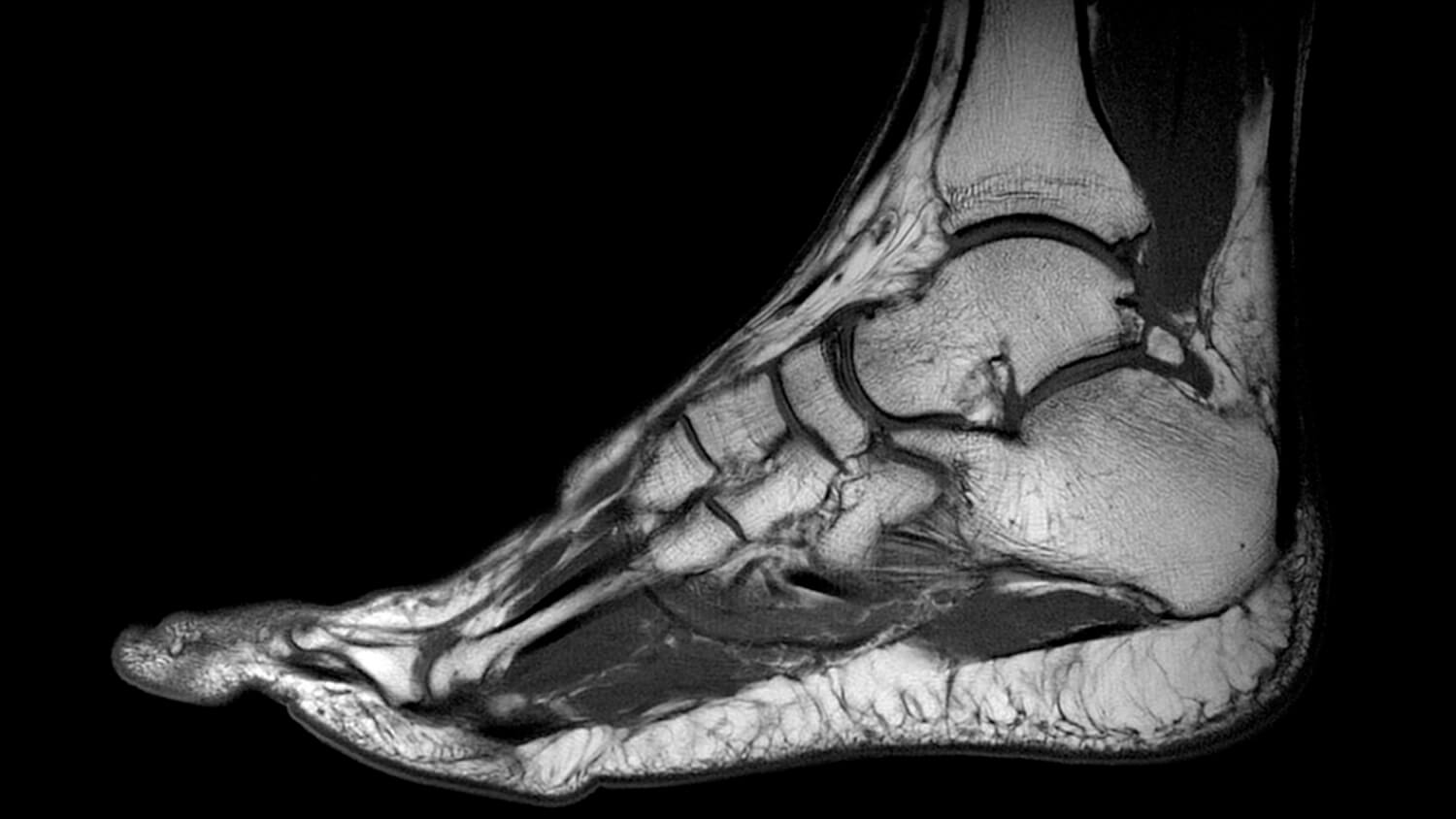 Foot Muscles Mri Mri In Foot Pain Tohtoha