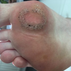 Verruca hurting foot, Verruca foot black dots