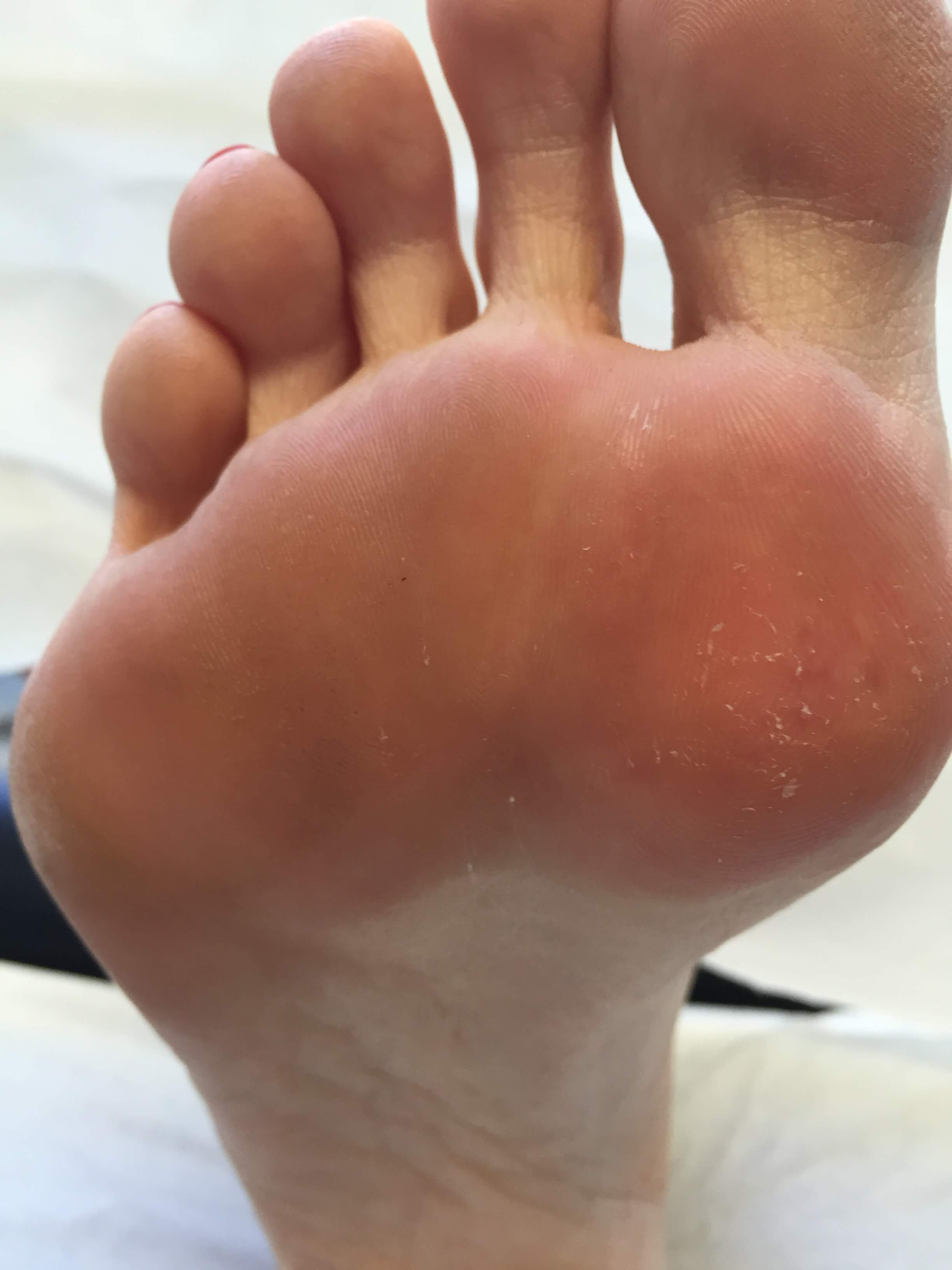 Verruca hurting foot, Verruca foot black dots